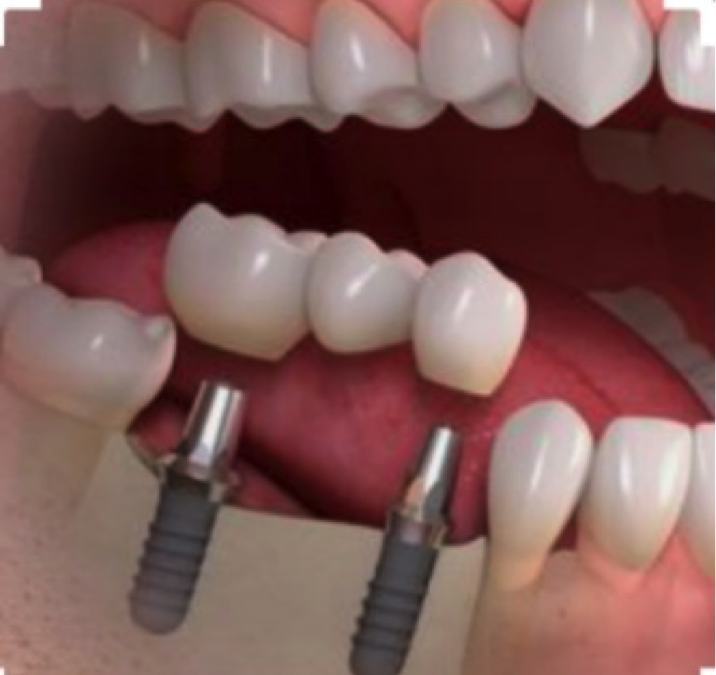 Same Day Dental Implant Near Me Dental Implant Procedures   Untitled 4 716x675 