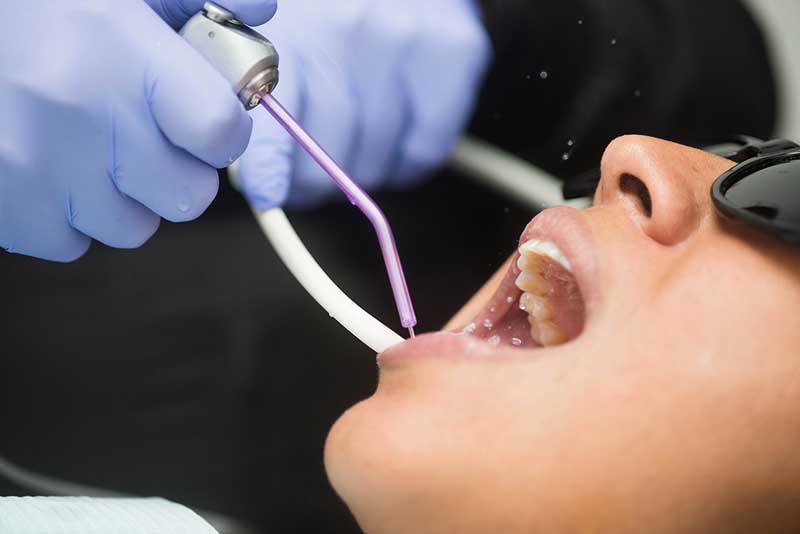 Newhall Dentist Improves Gum Health With A Deep Cleaning