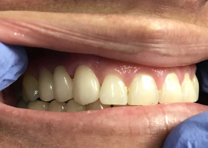 Dental Bridge Before And After Pictures