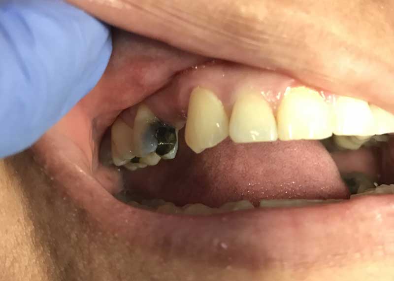 Dental Bridge Before And After Pictures