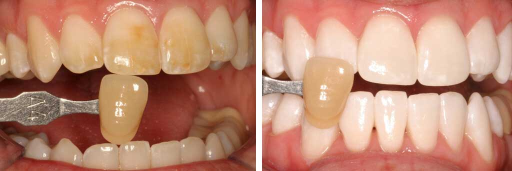  teeth whitening before and after