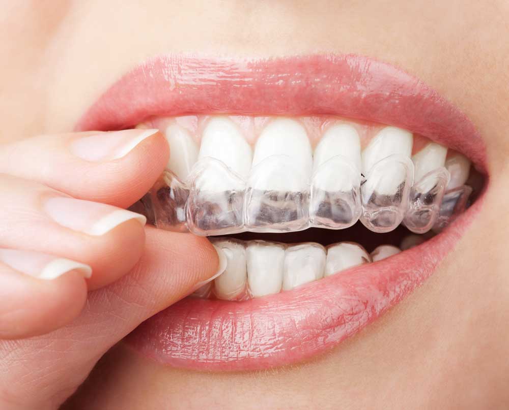 INVISALIGN TREATMENT