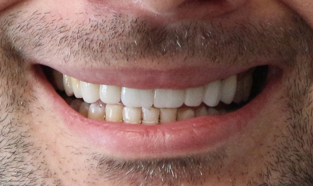 before and after dental implants