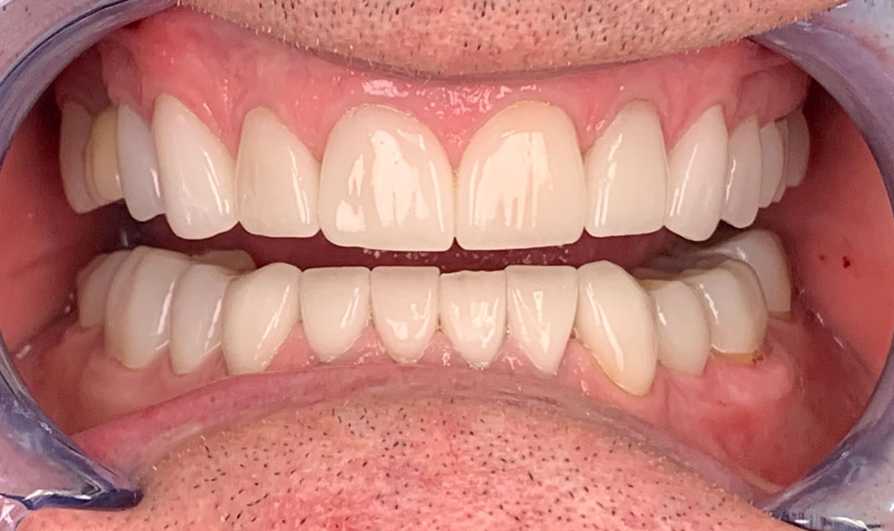 before and after veneers