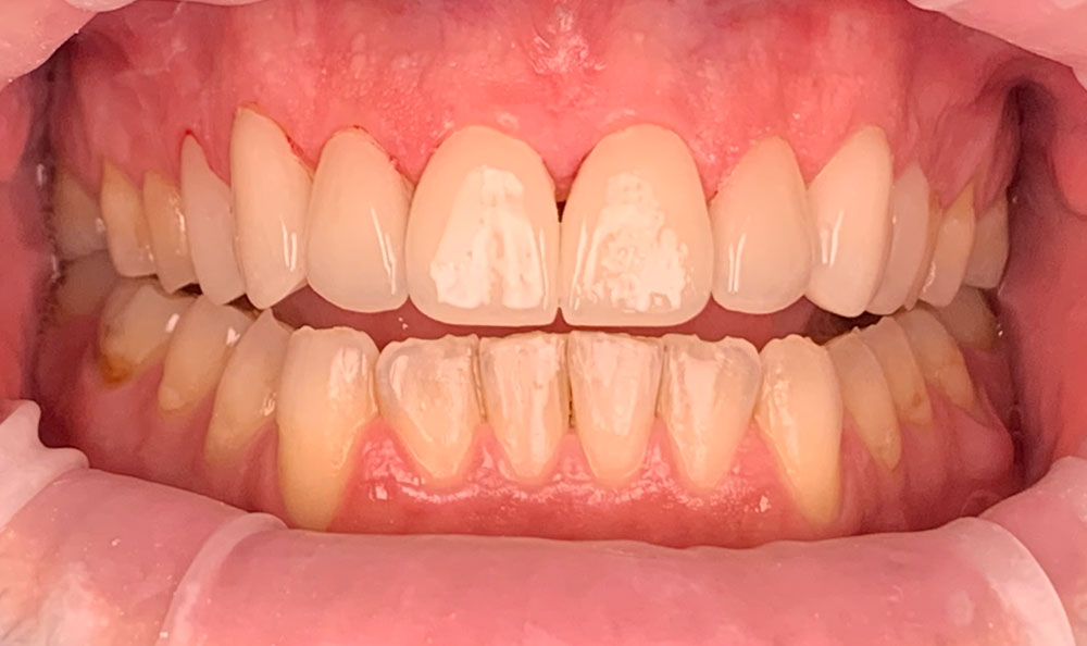  veneers before and after