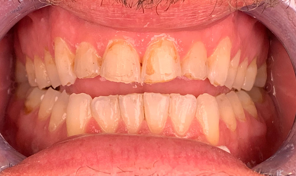 veneers before and after